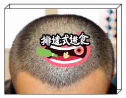 -大麦微针植发全国连锁