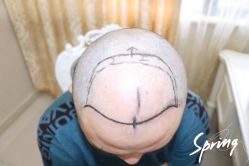 点击看大图 体验后-大麦微针植发全国连锁