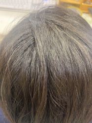 -碧莲盛·不剃发植发