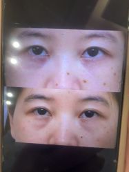 -广州健丽·去眼袋医疗美容机构