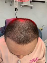 -大麦微针植发全国连锁