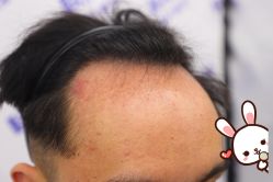 -大麦微针植发丨全国连锁