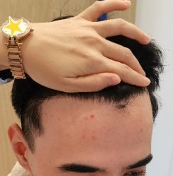 -大麦微针植发丨全国连锁