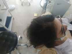 -大麦微针植发丨全国连锁