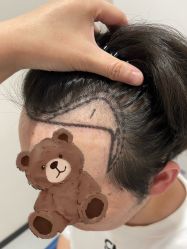 -大麦微针植发全国连锁