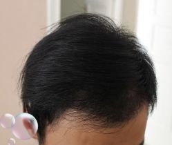 -大麦微针植发丨全国连锁