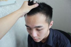 点击看大图 -大麦微针植发丨全国连锁