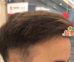 -大麦微针植发全国连锁