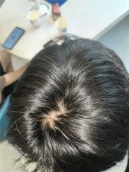 体验前-大麦微针植发全国连锁