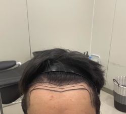 -碧莲盛·不剃发植发