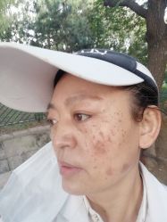 -痣清宫祛斑祛痣连锁店