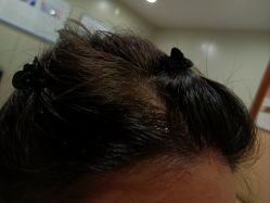 -碧莲盛·不剃发植发