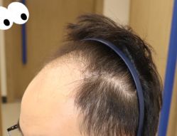 -大麦微针植发全国连锁