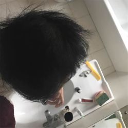 -碧莲盛·不剃发植发