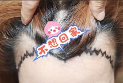 -大麦微针植发全国连锁