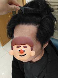 -大麦微针植发丨全国连锁