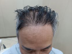 -大麦微针植发全国连锁