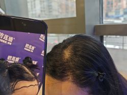 -碧莲盛·不剃发植发