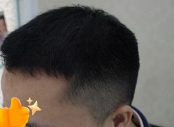 -大麦微针植发丨全国连锁