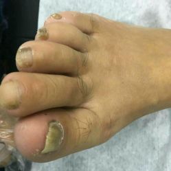 -德哥灰指甲脚气甲沟炎跖疣护理