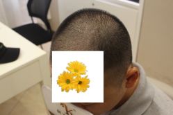 -大麦微针植发丨全国连锁