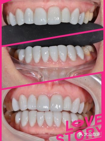 天呐，好喜欢现在的牙齿，性价比很高，钱花值了！