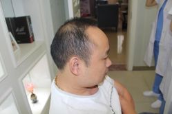 -大麦微针植发丨全国连锁