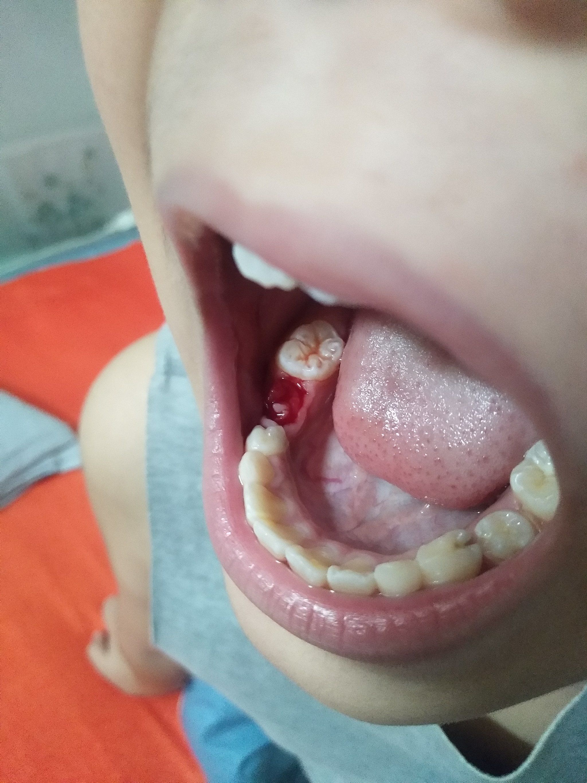 天天领红包 #窝沟封闭 #口腔 #儿童