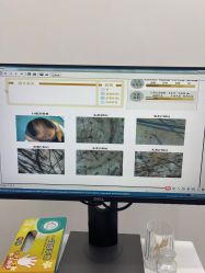 -大麦微针植发全国连锁