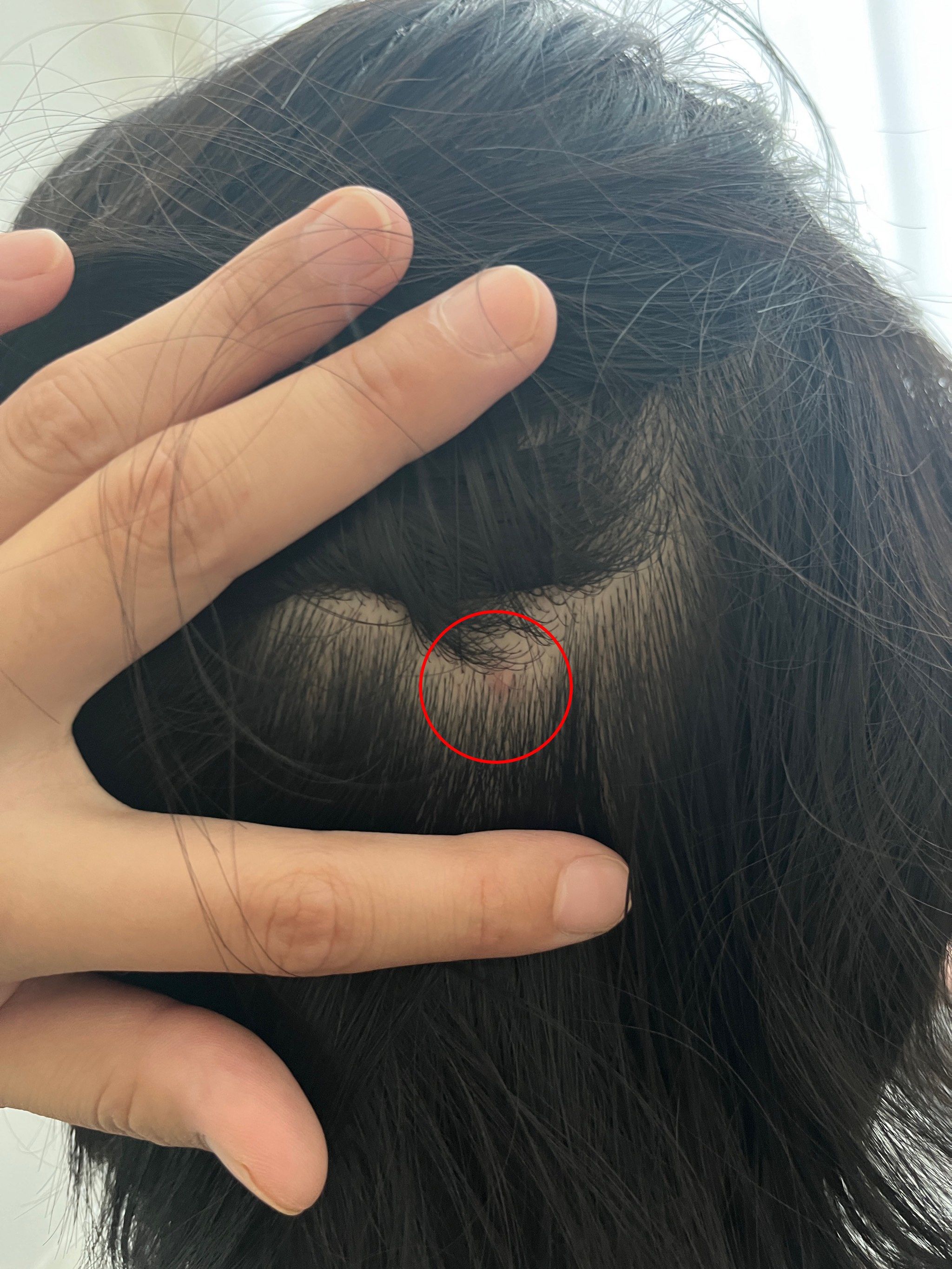 头上长痘痘是缺乏维生素什么为什么在线