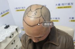 -大麦微针植发丨全国连锁