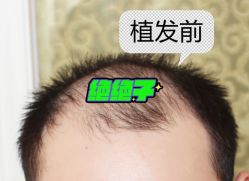 -大麦微针植发全国连锁