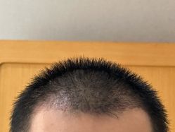 -大麦微针植发丨全国连锁