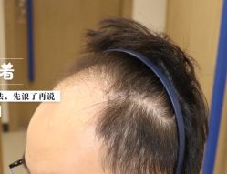 -大麦微针植发全国连锁