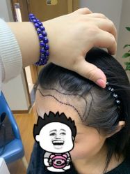 -大麦微针植发全国连锁