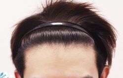 -大麦微针植发丨全国连锁