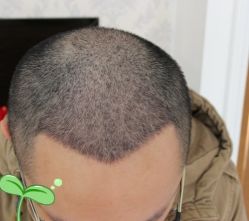 -大麦微针植发丨全国连锁