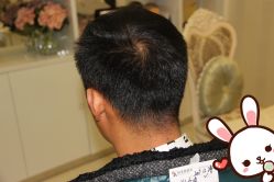 点击看大图 -大麦微针植发丨全国连锁