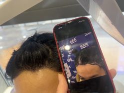 -碧莲盛·不剃发植发