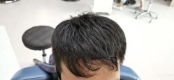 点击看大图 -大麦微针植发全国连锁