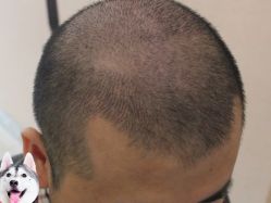 -大麦微针植发丨全国连锁