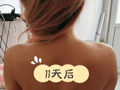 体验后-More摩尔医美の注射线雕光电中心