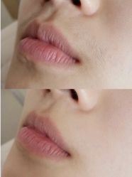 -薇兰专业脱毛连锁机构