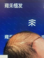 -雍禾植发全国连锁