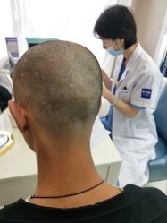 点击看大图 -大麦微针植发丨全国连锁