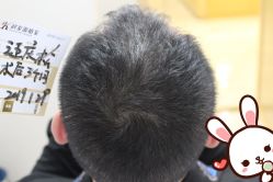 点击看大图 -大麦微针植发丨全国连锁