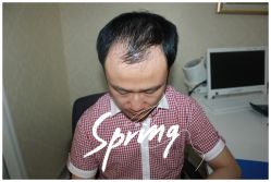 -大麦微针植发全国连锁