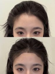 -大麦微针植发全国连锁