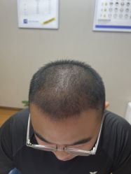 体验后-大麦微针植发全国连锁
