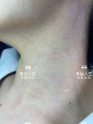 -爱莎扁平疣·汗管瘤·斑痣中心